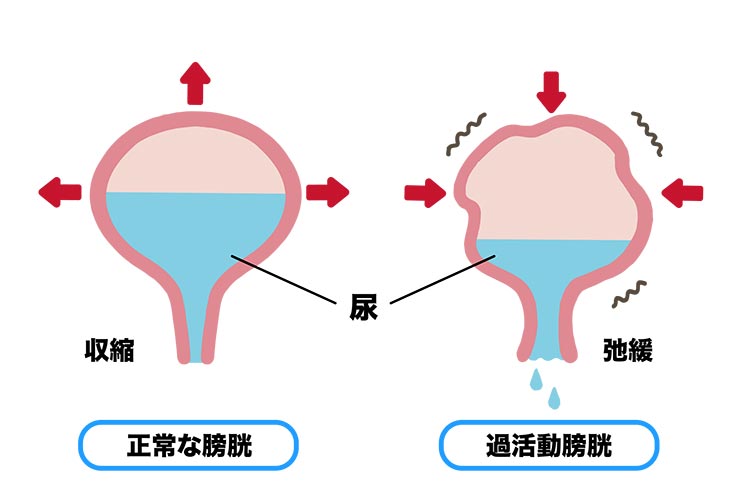 過活動膀胱イメージ