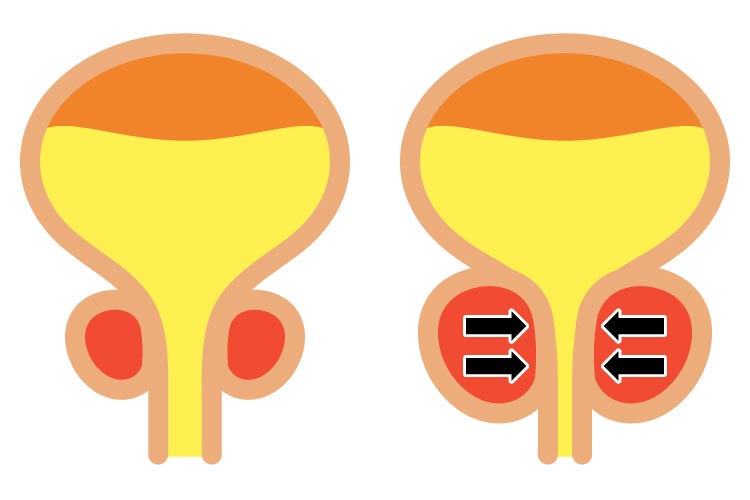 前立腺肥大症イメージ