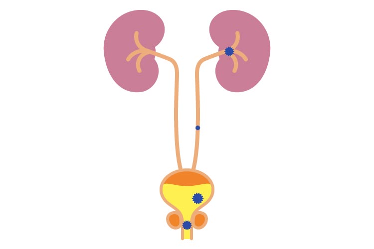 尿路結石症イメージ