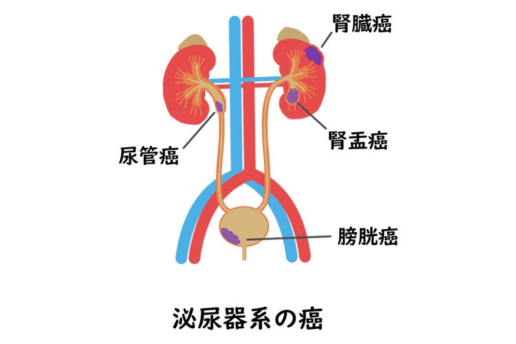 泌尿器がんイメージ