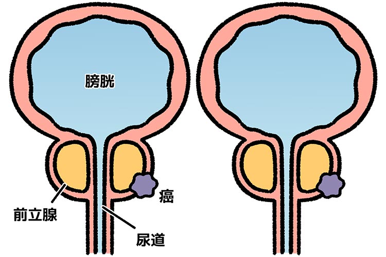 前立腺がんイメージ